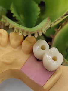 Cemented Solution NOBEL BIOCARE Dental Implants Crown