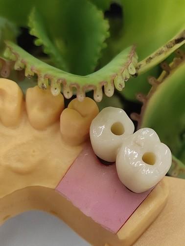 Quality Cemented Solution NOBEL BIOCARE Dental Implants Crown for sale
