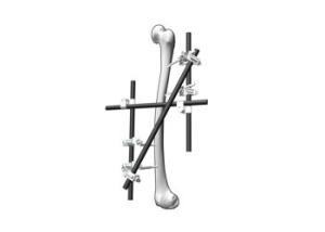 Buy cheap Multipurpose External Fixation System For Serious Backbone Fractures product
