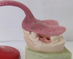 Custom Denture Impression Trays