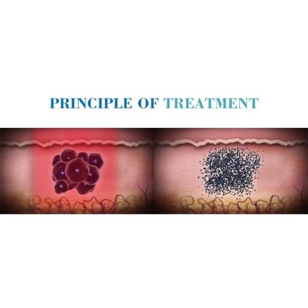 Professional picosecond picosure laser tattoo removal machine with Medical CE certification quick tattoo removal