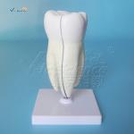 Teeth Anatomical Model Molar Tooth Attach With Caries Maxillary 3 Roots Magnify