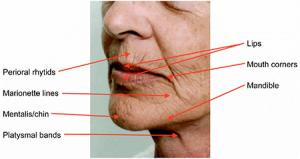 Derm / Medium Line Mesotherapy Hyaluronic Acid For Lips Enhancement