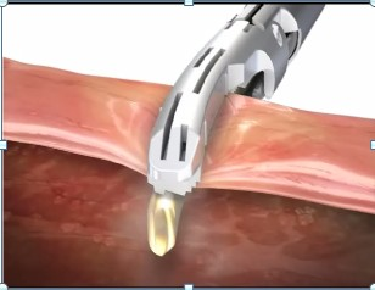 Coagulation Harmonic Knife Ultrasonic Endo Cutter Stapler System