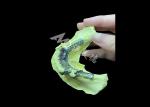 Tailored Cast Partial Denture with Personalized Aesthetics and Secure Fit for