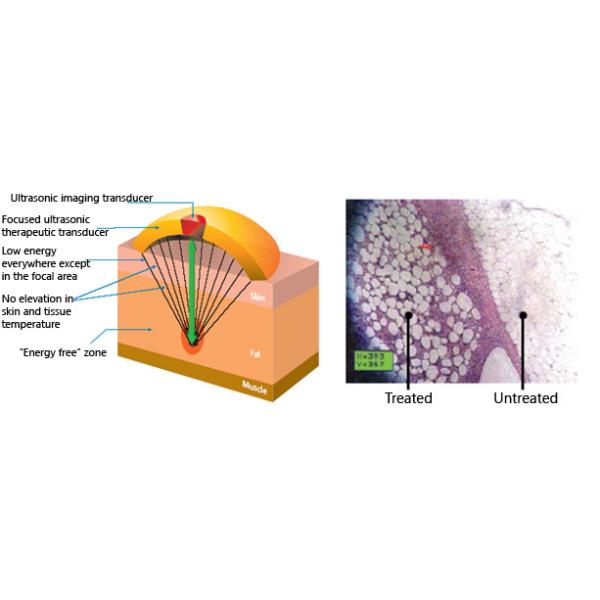 NEWS!!! Featured HIFUShape hifu slimming machine hifu ultherapy