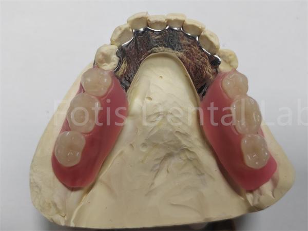 Quality OEM Flexible Removable Partial Denture  Easy To Clean / Maintain for sale