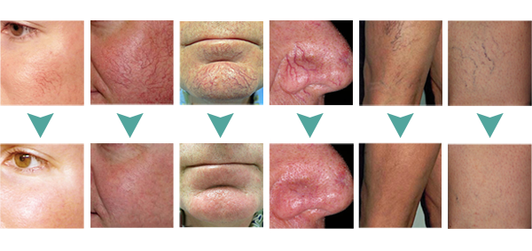 Laser Vascular therapy spider vein removal machine 2018 mole removal