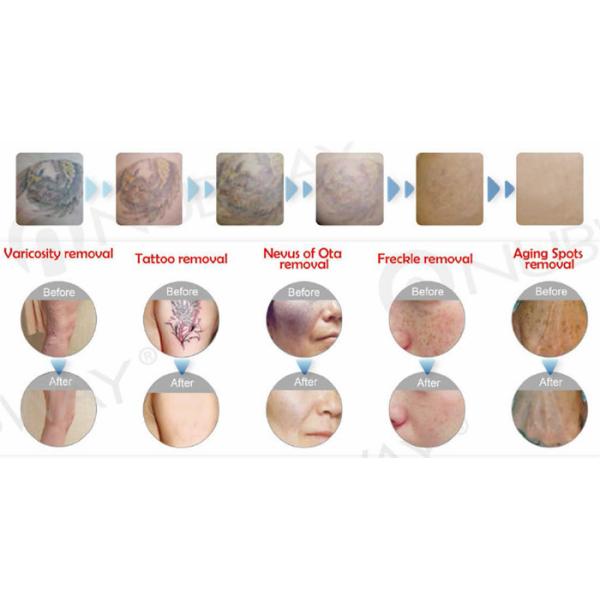 2017 Newest! High Power long pulse width Q Switch Tattoo Removal nd Yag Laser Machine