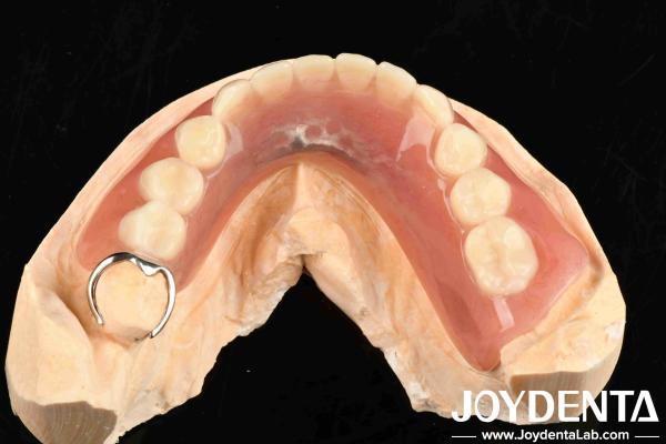 Quality Metals And Resins Framework Set Up Teeth Finish For Stable Oral Structure In Dental Configuration for sale