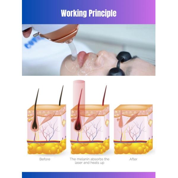 GOMECY 4 Wavelengths Ice Laser Pigmentation Removal Machine 808nm 1064nm 980nm For Salon