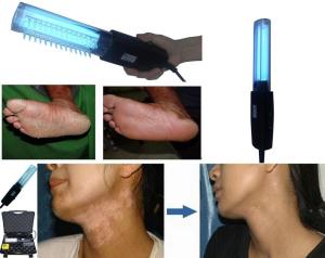 China Portable 311nm Uvb Phototherapy Lamp 250V Vitiligo Lamp Treatment on sale
