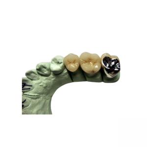 China High Biocompatibility PFM Crown Porcelain Fused For Back Teeth Restoration on sale