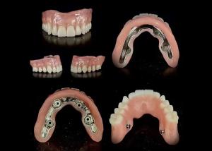 Precise Bar Implant Supported Hybrid Denture Secure Fit Adjustable Stability