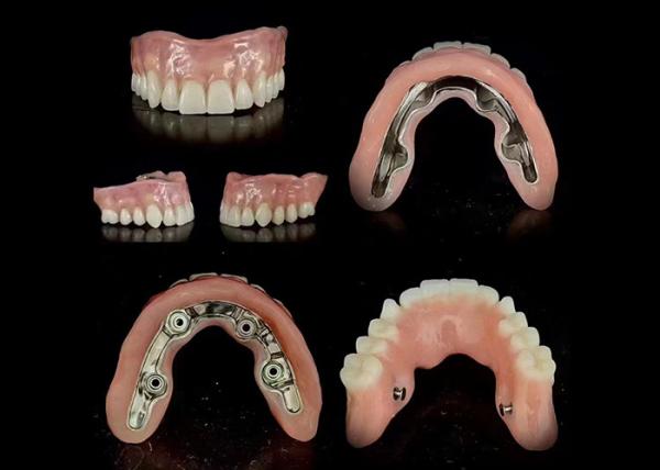 Quality Precise Bar Implant Supported Hybrid Denture Secure Fit Adjustable Stability for sale