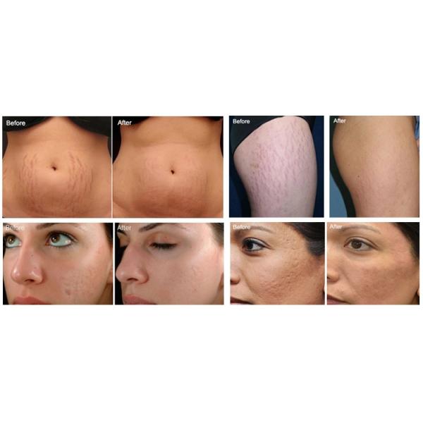 Sincoheren Skin Tightening RF Machine / Microneedling Radio Frequency Beauty Machine