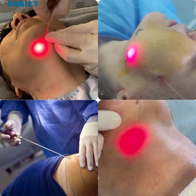 Newest Endolaser 1470nm 980nm Diode Laser Face Lifting Liposuction Machine Air Cooling