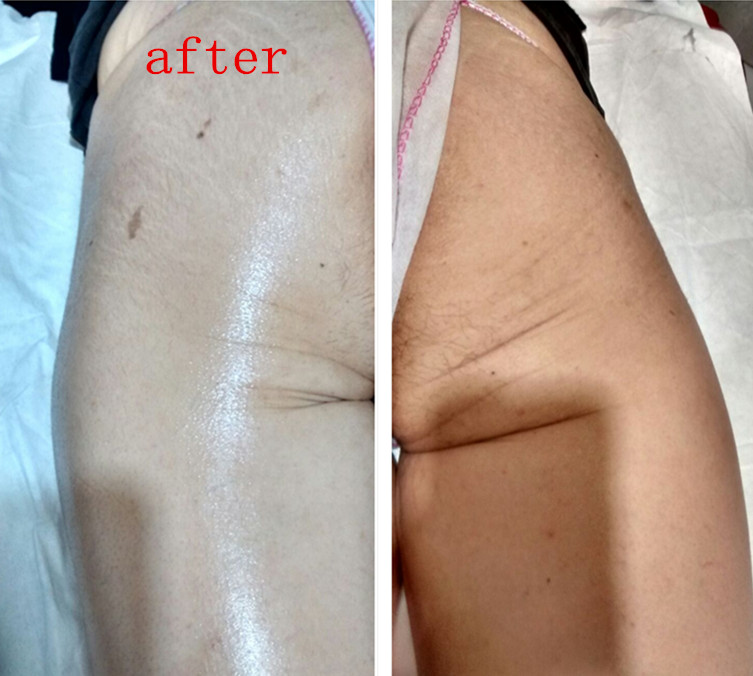 Skin Rejuvenation Machine Face Wrinkle Removal Machine Jowl lifting