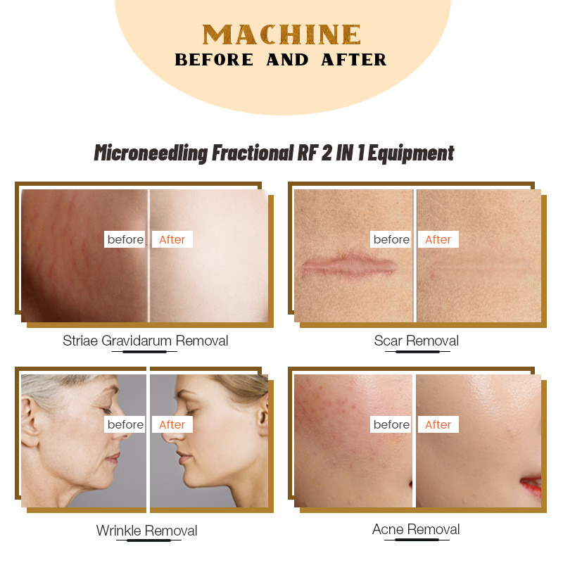 Skin Rejuvenation Fractional RF Microneedle Machine 5MHZ Radio Frequency