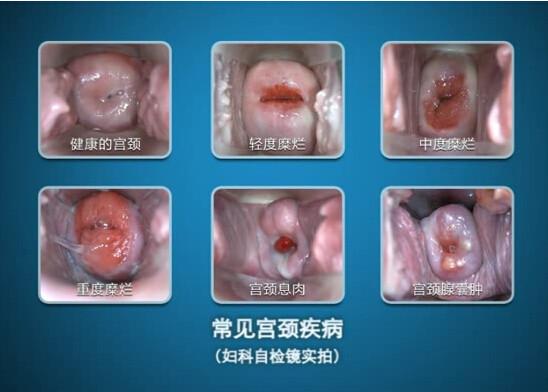 High Definition Display Digital Electronic Colposcope Portable Device to Check