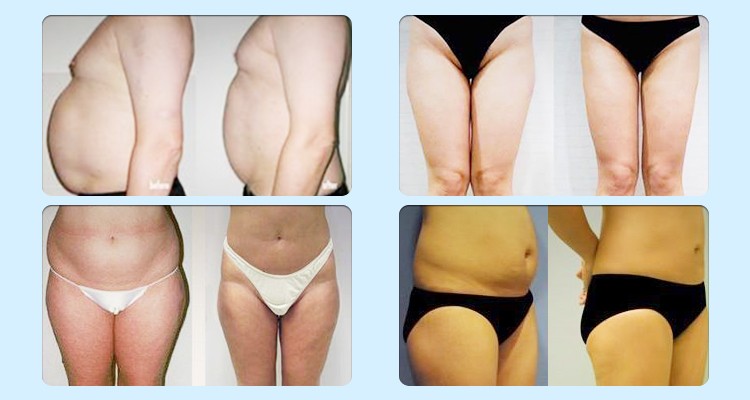 Face / Neck Lifting RF Cavitation Slimming Machine Weight Reduction Beauty Machine