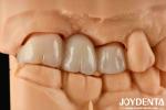 Experience Color Realistic Full Zirconia With High Resistance To Staining And