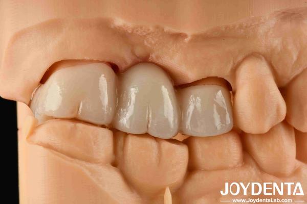 Quality Experience Color Realistic Full Zirconia With High Resistance To Staining And Flexural Strength Of 1000 MPa for sale