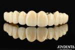 Custom-made Ti-Bar Zirconia Hybrid Bridge The Perfect Combination For Comfort