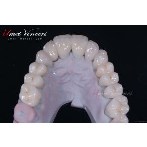 Natural Bright White Veneers