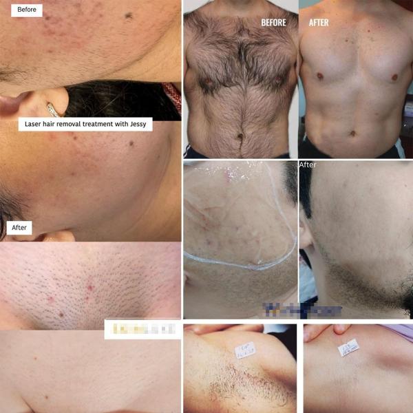 Permanent Hair Removal Diode Laser Machine 1200W For All Skin Types