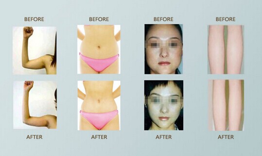 Smart Air cooling belly fat laser liposuction equipment for cellulite treatment