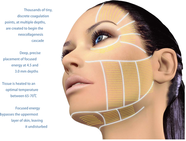 portable radio frequency hifu face lift device radio frequency face lift machine