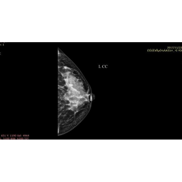 Full Digital Mammography System with Panel Detector for Sales