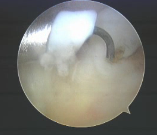 Hip Joint Probe Surgical Instrument One Time Use With No Carbonization