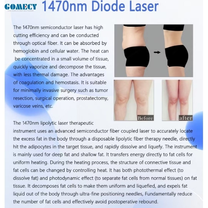 Newest Endolaser 1470nm 980nm Diode Laser Face Lifting Liposuction Machine Air Cooling
