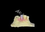 Nesbit Flexible Partial Denture for Comfort and Durability in Tooth Replacement