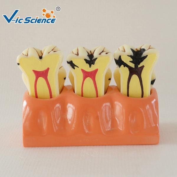 Quality Decayed Tooth Orthodontic Study Models 4 Times Caries Disassembling Model for sale