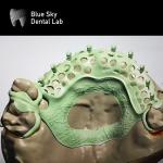 Removable Denture Rpd Framework Design Metal Partial Denture Framework Design