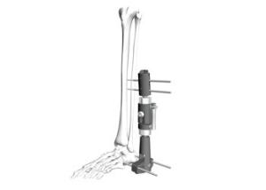 Buy cheap Infected Nonunion Orthopedic External Fixation Device With Hex Wrench product