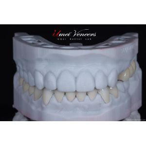 Super Natural Hollywood Veneers