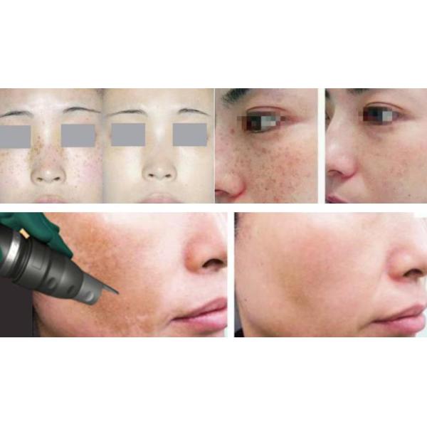 Multifunction E Light Beauty Equipment / E Light Ipl Machine For Tattoo Removal