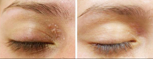 Mole Removal CO2 Fractional Laser Machine , CO2 Laser Machine For Acne Scars