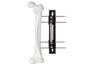 Medical External Fixator of bone lengthening, light and easy to do the operation