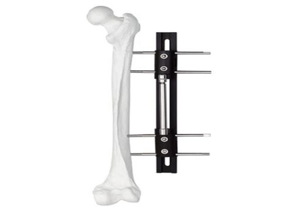 Quality Medical External Fixator of bone lengthening, light and easy to do the operation for sale