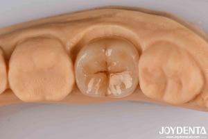 High Precision Applications Full Zirconia With High Resistance To Thermal Shock