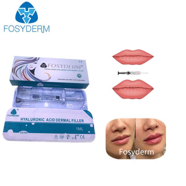 Quality Hyaluronic Acid Injectable Dermal Filler 1ml 2ml For Lips Augmentation for sale