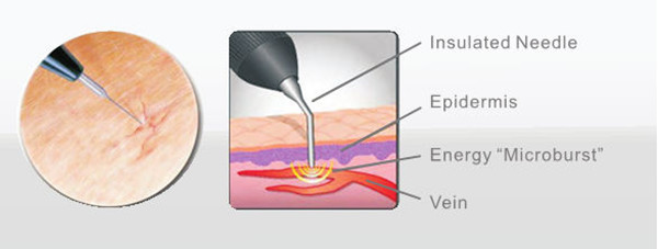High frequency vascular removal machine best treatment for spider veins on face and body