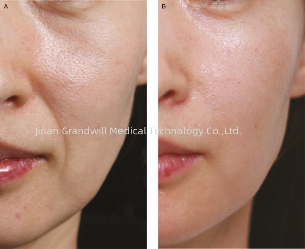 Quality PCL Cross Linked Hyaluronic Acid Dermal Filler Polycaprolactone for sale