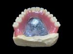 Easy-to-Clean Custom Cast Partial Dentures Ideal for Restoring Chewing Ability