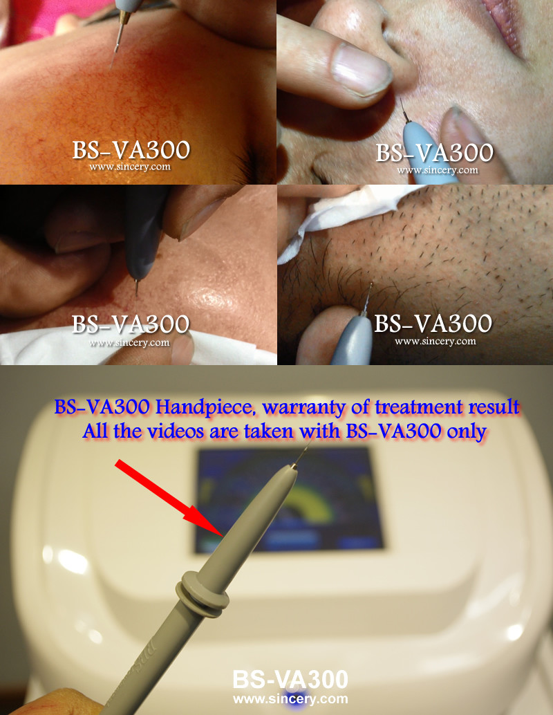 High Frequency Red Blood Vascular Removal Machine With Pulse / Continuous Work Mode